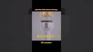 ACP or plasma rich platelets therapy acp plasma rich platelets therapy plasmarichplatelets pl [upl. by Yrocej510]