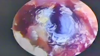 Processing fungal thick dry patches on the eardrum earwax Cleaning earwaxremoval satisfying [upl. by Somar]