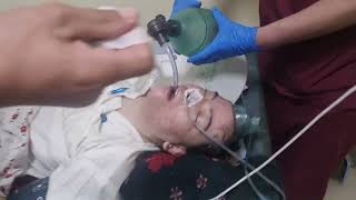 Rapid sequence intubation in HDU how to fast intubate Respiratory arrest patient [upl. by Jerrilee136]