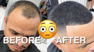 BEFORE amp AFTER From being BALD to FULL HEAD OF HAIR [upl. by Geoff]