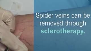 Safely Remove Spider Veins with Sclerotherapy [upl. by Chucho639]