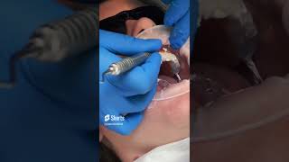 Composite Veneers Transformation [upl. by Dutch]