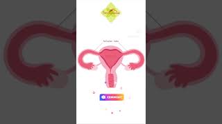 Fallopian tube blockage Treatment without operation fallopiantubeblockage uttarbastti infertility [upl. by Chandos]