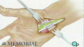 Carpal Tunnel Syndrome Repair Surgery [upl. by Dalury]