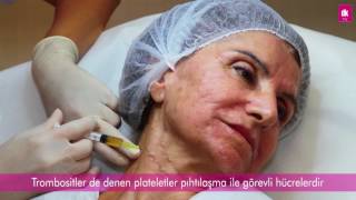 PRP İle Yüz Gençleştirme  Antalya  DK Klinik [upl. by Crisey]