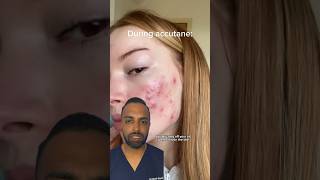 How does ACCUTANE work Dr Somji Explains [upl. by Speroni]