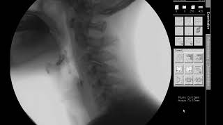 Swallow Study  Solid TextureCracker  Modified Barium Swallow Study MBSS Lateral View HD [upl. by Alisa]