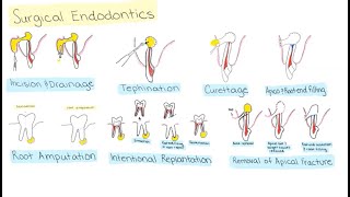 Surgical Endodontics [upl. by Iur]