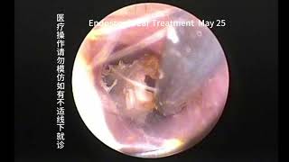 Cleaning of cerumen embolism after soaking in drops of medicine [upl. by Garvy]