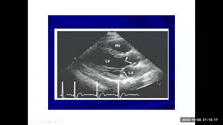 12 Cardiopatía Valvular Aórtica y Pulmonar [upl. by Grey]