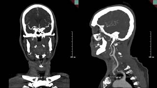 Endovascular mgmt of basilar artery occlusion secondary to fusiform aneurysm w intraluminal thrombus [upl. by Abrams]