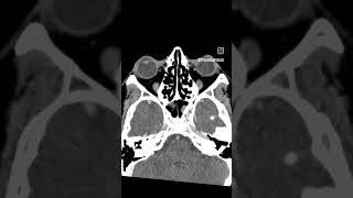 Case9 cect paranasal sinuses viral trending likesforlike commentsforcomments radiology [upl. by Kass]