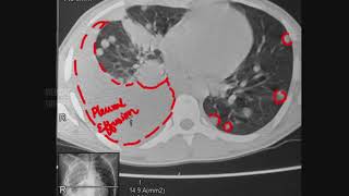 Pulmonary  Lung Metastasis • Radiology and Mechanism [upl. by Larret]