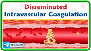 Disseminated Intravascular coagulation Animation  Pathogenesis Morphology Diagnosis Treatment [upl. by Sly]