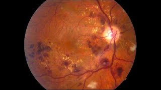 RETINOPATÍA DIABÉTICA CAUSAS SÍNTOMAS Y TRATAMIENTO TRATAMIENTO LÁSER PARA RETINOPATÍA DIABETES [upl. by Boles]