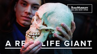 WE HAVE A GIANT Exploring the Rare Condition of Gigantism  The Bone Museum [upl. by Ardnasac767]