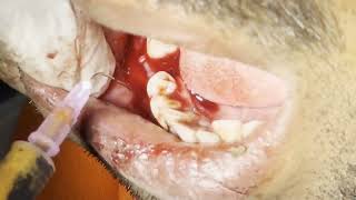 Explosive Dental abscess drainage and tooth extraction  Live On Patient [upl. by Rannug419]