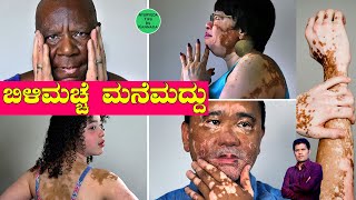 Bili Macche Mane Maddu  Bili Chibbu ge Mane Maddu Kannada  White Patches on Skin in kannada [upl. by Bartholemy]