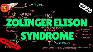 ZOLINGERELISON SYNDROME Pathogenesis Diagnosis Treatment [upl. by Shelburne]