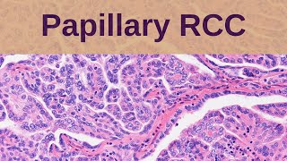 Papillary Renal Cell Carcinoma  Pathology mini tutorial [upl. by Mccormac863]