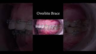 Overbite brace before after shorts braces orthodontist [upl. by Anilemrac]