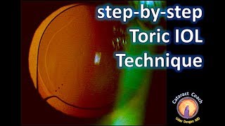 StepbyStep Technique for Toric IOLs  Beautifully performed cataract surgery [upl. by Anil973]