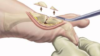 Big Toe Joint Implant Surgery for Arthritis by San Francisco Podiatrist [upl. by Bullock329]