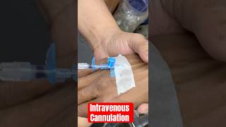 Intravenous Cannulation  Cannulation trending shorts medicalequipment medicine medicine [upl. by Ybor]