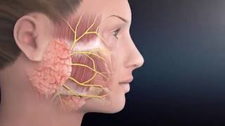 Parotid Surgery Animation  Overview of Minimally Invasive Parotidectomy [upl. by Nafets607]