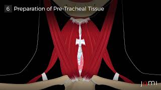 Transoral Endoscopic Thyroidectomy Vestibular Approach TOETVA Steps [upl. by Roque150]