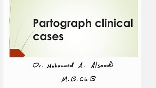 partogram with clinical cases [upl. by Weiner983]