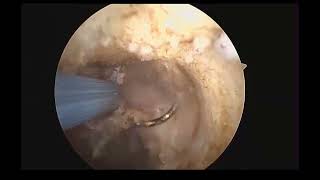 Hysteroscopic Istmocele Operation [upl. by Ginny]