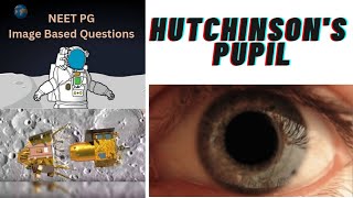 NEET PG Hutchinson pupil amp Kernohan notch imagebasedquestion neetpg neetpgpreparation sureshot [upl. by Esidnac467]