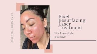 Pixel Resurfacing Laser Treatment  Was it worth the process [upl. by Gaylene94]