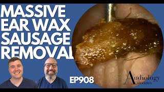 MASSIVE EAR WAX SAUSAGE REMOVED FROM PATIENTS EAR  EP908 [upl. by Novaat]