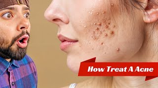 HOW TO TREAT DIFFERENT TYPES OF ACNE [upl. by Eidnam897]