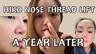 MY NOSE AFTER A YEAR OF HIKO NOSE THREAD LIFT [upl. by Noek]