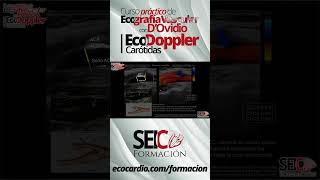 Curso Práctico de Ecografía Vascular  Eco Doppler Carótidas [upl. by Dahle3]