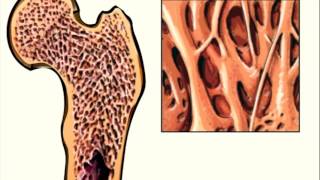 Abaloparatide approved for HighRisk Osteoporosis Patients [upl. by Aika105]