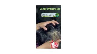 Dandruff Removal  Scratching a Patch of Dandruff Flaky Scalp  itchy scalp ASMAR Scalp care [upl. by Yggep960]