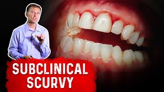 Vitamin C Deficiency Subclinical Scurvy – Causes Symptoms and Remedies – Dr Berg [upl. by Noreht]