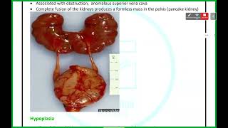 UGS Pathology  Anomalies amp Cystic Kidney Diseases  Mutah [upl. by Aicyle]