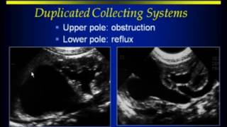 RenalAdrenalRetroperitoneal Ultrasound [upl. by Ohcirej740]