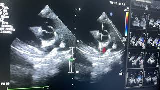 Complete AV Septal defect Double outlet RV severe Pulmonary stenosis Glen shunt [upl. by Aicilihp551]