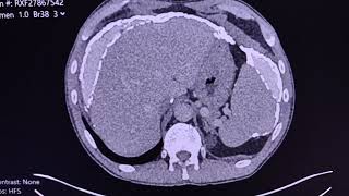 Haemodialysis related peritoneal calcifications and encapsulated peritoneal sclerosis and osteopathy [upl. by Suoiradal]