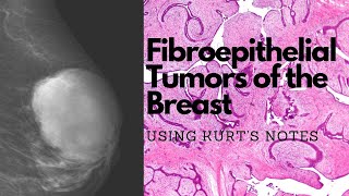 Fibroadenomas and Phyllodes Tumor of the Breast Using Kurt’s Notes pathagonia [upl. by Jeanie842]