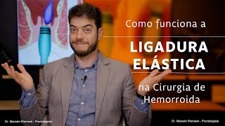 Como Funciona a Ligadura Elástica na Cirurgia de Hemorroida [upl. by Mcgurn]