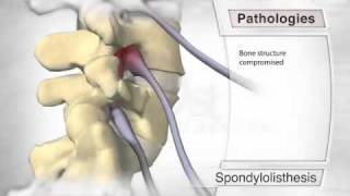 Spondylolisthesis Pathology [upl. by Maisie956]