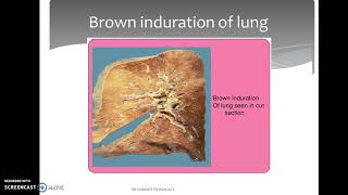 Hyperemia and Congestion [upl. by Soloman]