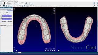 Software Nemocast para diseño de tratamiento de alineadores y para cementacion digital [upl. by Nimajnab161]